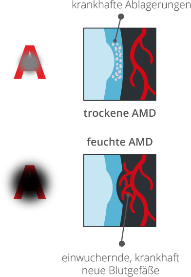 AMD Behandlung